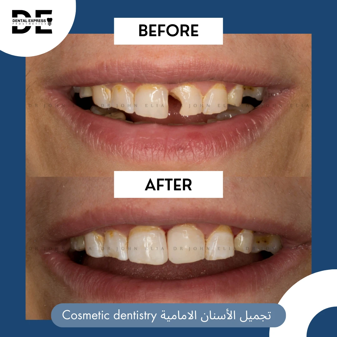 صور الحالة قبل العلاج وبعده: تجميل الأسنان الأمامية