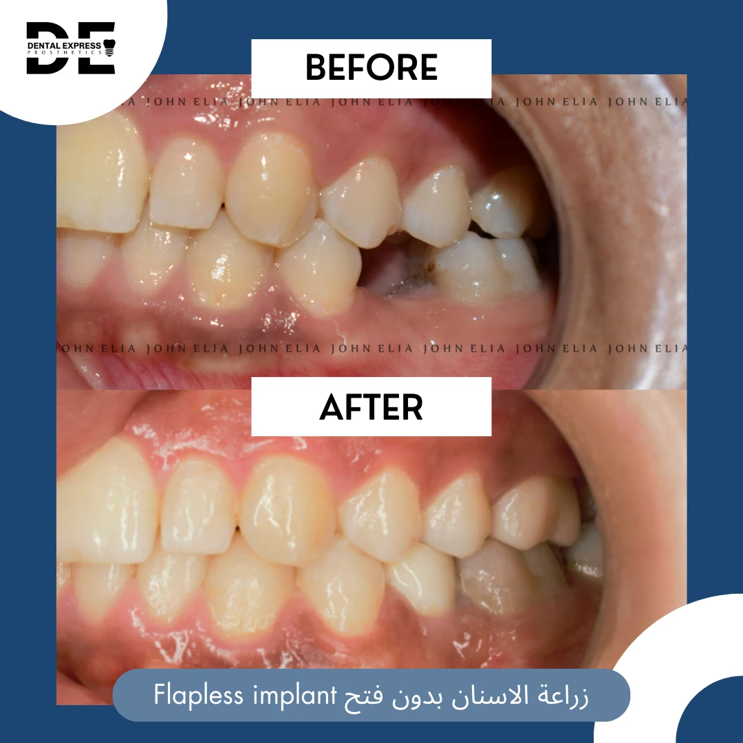 صور الحالة قبل العلاج وبعده: زراعة الأسنان